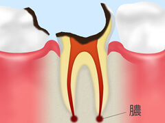 歯を保存できない重度の虫歯